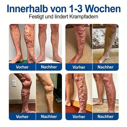 Offizieller Markenstore✅🎉𝑭𝒍𝐨𝐫𝒊𝘀𝒎𝙖® 𝑽𝒆𝒊𝒏𝑻𝒂𝒓𝒈𝒆𝒕 𝑴𝒊𝒌𝒓𝒐𝒏𝒂𝒅𝒆𝒍-𝑷𝒇𝒍𝒂𝒔𝒕𝒆𝒓 ⚡ Sofortige Linderung, langfristige Wirkung