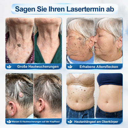 Offizieller Markenstore |✅𝑷𝑖𝒄𝐝𝐨® 7-𝑻𝒂𝒈𝒆 𝑯𝒂𝒖𝒕𝒂𝒏𝒉ä𝒏𝒈𝒔𝒆𝒍- & 𝑭𝒍𝒆𝒄𝒌𝒆𝒏𝒆𝒏𝒕𝒇𝒆𝒓𝒏𝒆𝒓(Schmerzfreier Rollerball – Keine Narbenbildung)🎉