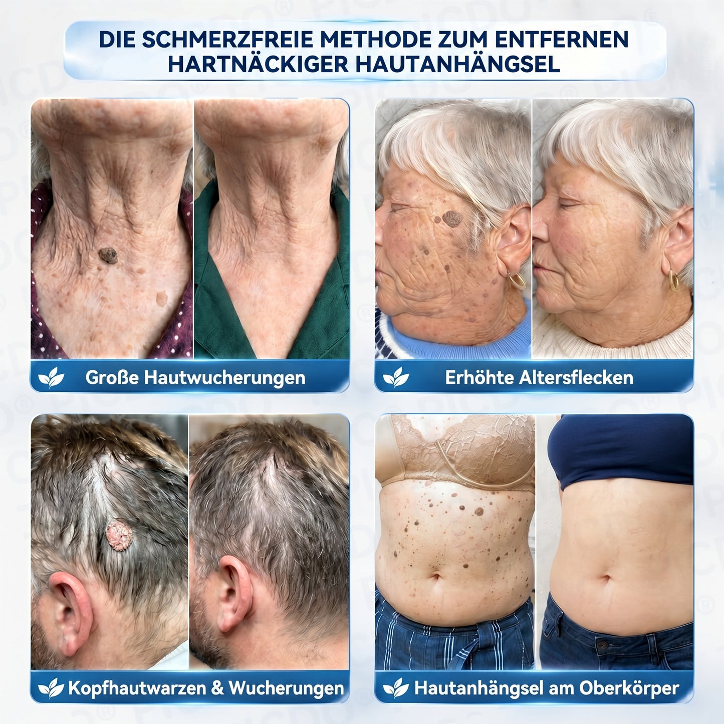 𝐏𝐢𝐜𝐝𝐨® 𝟕-𝐓𝐚𝐠𝐞 𝐇𝐚𝐮𝐭𝐚𝐧𝐡ä𝐧𝐠𝐬𝐞𝐥- & 𝐅𝐥𝐞𝐜𝐤𝐞𝐧-𝐄𝐧𝐭𝐟𝐞𝐫𝐧𝐮𝐧𝐠𝐬𝐜𝐫𝐞𝐦𝐞 (𝐒𝐜𝐡𝐦𝐞𝐫𝐳𝐟𝐫𝐞𝐢𝐞 𝐅𝐨𝐫𝐦𝐞𝐥 – 𝐨𝐡𝐧𝐞 𝐍𝐚𝐫𝐛𝐞𝐧) 🌹