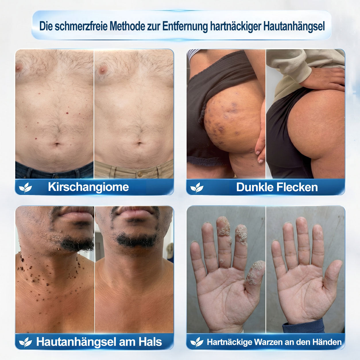 Offizieller Markenstore |✅𝑷𝑖𝒄𝐝𝐨® 7-𝑻𝒂𝒈𝒆 𝑯𝒂𝒖𝒕𝒂𝒏𝒉ä𝒏𝒈𝒔𝒆𝒍- & 𝑭𝒍𝒆𝒄𝒌𝒆𝒏𝒆𝒏𝒕𝒇𝒆𝒓𝒏𝒆𝒓(Schmerzfreier Rollerball – Keine Narbenbildung)🎉