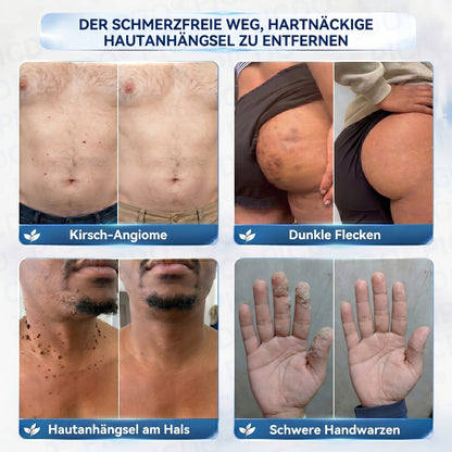 𝐏𝐢𝐜𝐝𝐨® 𝟕-𝐓𝐚𝐠𝐞 𝐇𝐚𝐮𝐭𝐚𝐧𝐡ä𝐧𝐠𝐬𝐞𝐥- & 𝐅𝐥𝐞𝐜𝐤𝐞𝐧-𝐄𝐧𝐭𝐟𝐞𝐫𝐧𝐮𝐧𝐠𝐬𝐜𝐫𝐞𝐦𝐞 (𝐒𝐜𝐡𝐦𝐞𝐫𝐳𝐟𝐫𝐞𝐢𝐞 𝐅𝐨𝐫𝐦𝐞𝐥 – 𝐨𝐡𝐧𝐞 𝐍𝐚𝐫𝐛𝐞𝐧) 🌹