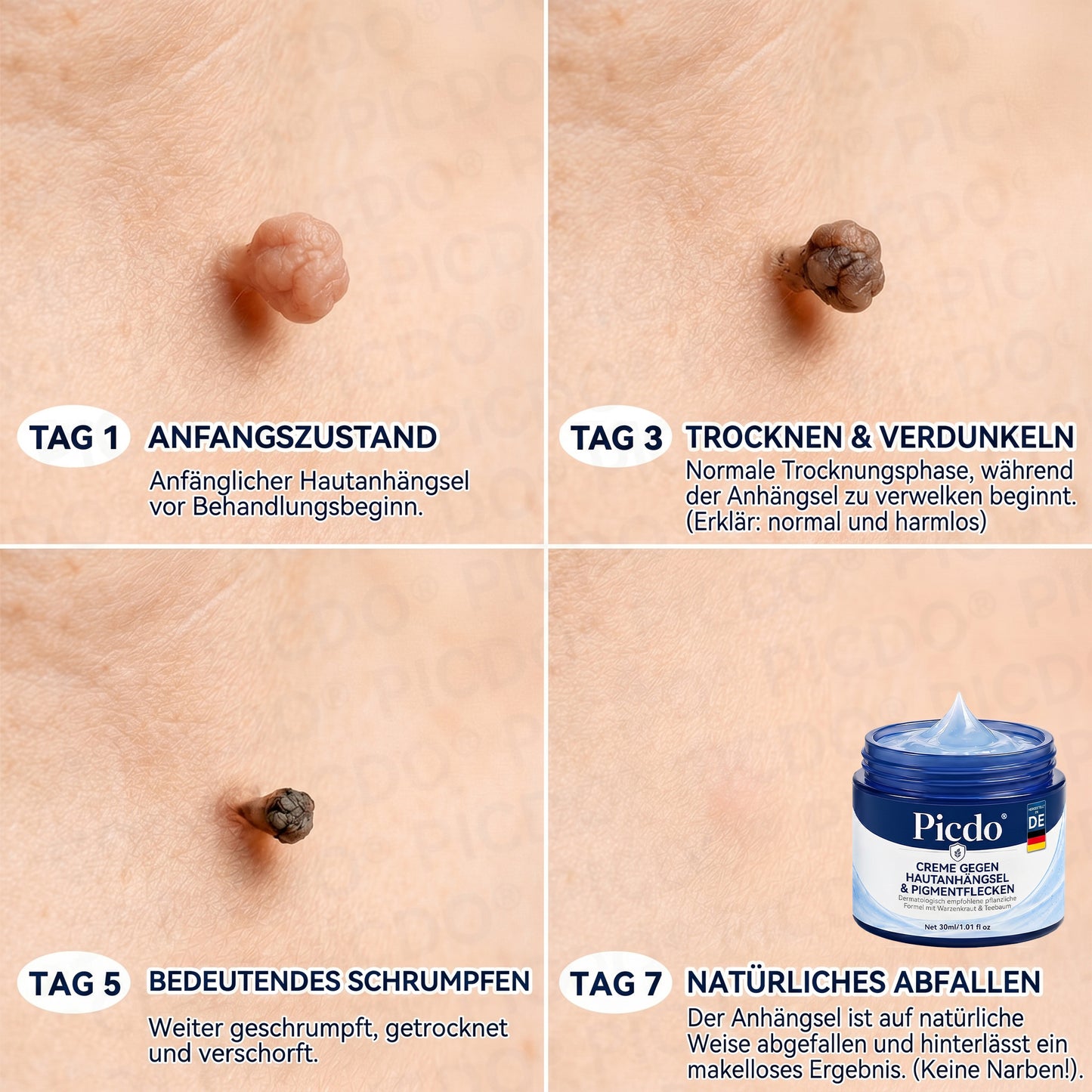 𝐏𝐢𝐜𝐝𝐨® 𝟕-𝐓𝐚𝐠𝐞 𝐇𝐚𝐮𝐭𝐚𝐧𝐡ä𝐧𝐠𝐬𝐞𝐥- & 𝐅𝐥𝐞𝐜𝐤𝐞𝐧-𝐄𝐧𝐭𝐟𝐞𝐫𝐧𝐮𝐧𝐠𝐬𝐜𝐫𝐞𝐦𝐞 (𝐒𝐜𝐡𝐦𝐞𝐫𝐳𝐟𝐫𝐞𝐢𝐞 𝐅𝐨𝐫𝐦𝐞𝐥 – 𝐨𝐡𝐧𝐞 𝐍𝐚𝐫𝐛𝐞𝐧) 🌹
